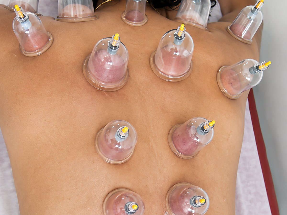 Cupping therapy in progress on a patient's back